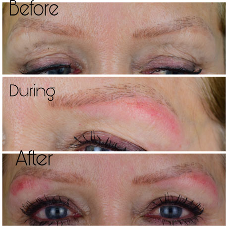 Eyebrow tattoo removal